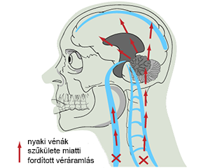 CCSVI elmélet CCSVI elmélet ábrája